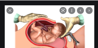 Caesarian-section rates rise