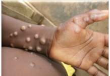 WHO declares monkey-pox a global health emergency