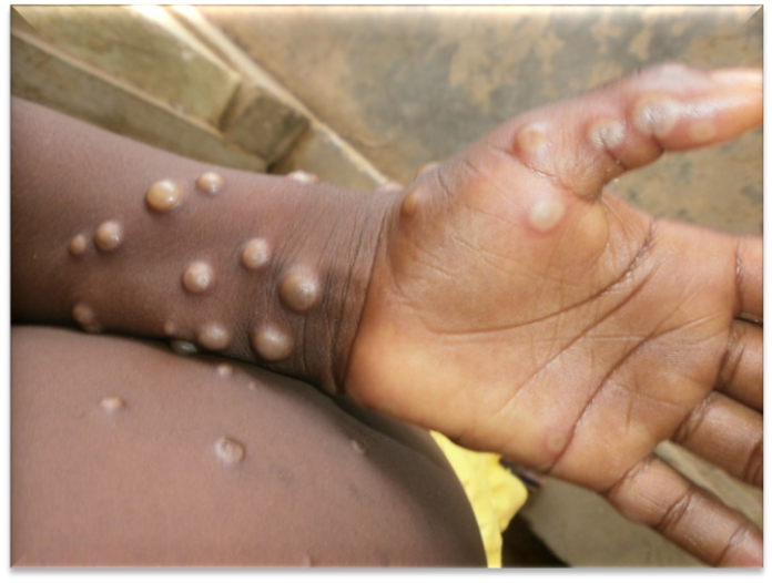 WHO declares monkey-pox a global health emergency