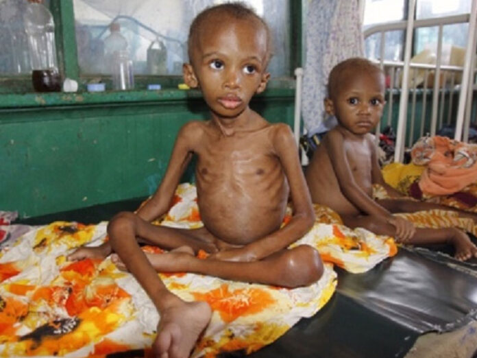 Malnutrition kills